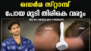 പോയ മുടി തിരികെ വരും  ഡെർമ സ്റ്റാമ്പ്  DERMA STAMP  MICRONEEDLING [upl. by Wickman]