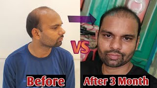 Hair Transplant 3 month journey  Hair transplant 90 days timelapse  Recover Hair Transplant [upl. by Onitnerolf]