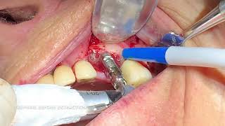 FULL OSSEOINTEGRATED IMPLANT REMOVAL [upl. by Nnil814]