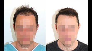 FUE Hair Transplantation for Hereditary Hair Loss  Result  Natural Hairline  3046 FUs [upl. by Winterbottom]