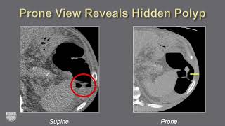 Tumor Imaging CT Colonography  Course Sample [upl. by Nilyad]