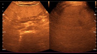 Fatty Liver  Diffuse hepatic steatosis  Liver Ultrasonogram [upl. by Ydnamron]