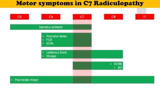 C7 Radiculopathy [upl. by Garry]