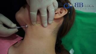 BBLock Thread Lifting for neck amp Double Chin [upl. by Aseela]