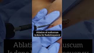 Molluscum Contagiosum Removal using Radiofrequency by Dr Charu Bansal MD Dermatologist skin doctor [upl. by Ahsito]