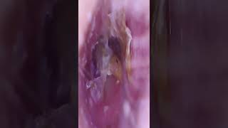 Ear Cleaning Asmr earwax earwaxclinic earspa [upl. by Yawnoc]