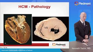 Hypertrophic Cardiomyopathy – Contemporary Approach to Diagnosis and Management [upl. by Acinnod]