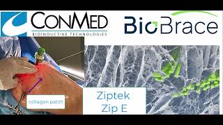 Ziptek Zip E Biorez Interpositional Collagen Graft [upl. by Oconnor324]