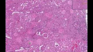 Histopathology KidneyDiabetic glomerulosclerosis [upl. by Nodlehs]