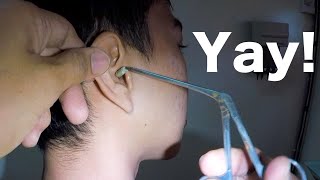 Something HUGE Stuck in Mans Ear for Weeks Finally Removed  What is It [upl. by Lymn]