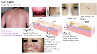 Understanding Rash in 3 minutes Skin Rash types and causes [upl. by Luane]