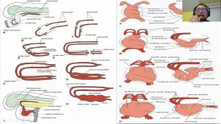 Ventricular Septal Defect [upl. by Bab]