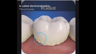 Stage 1 of Tooth Decay Demineralization [upl. by Eibur]