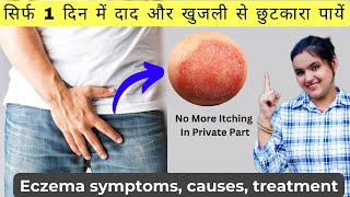 खुजली Eczema Treatment दाद खाज खुजली का इलाज  Atopic Dermatitis [upl. by Bowen]