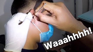 HUGE Earwax Stuck in Mans Ear Removed [upl. by Tamara]