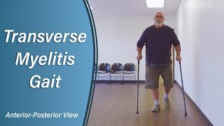 Transverse Myelitis Gait  Case Study 10 AnteriorPosterior [upl. by Aun]