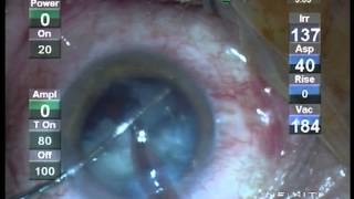 Operatie Cataracta Prof Dr Dorin Chiselita  Clinica Oftaprof [upl. by Fates]