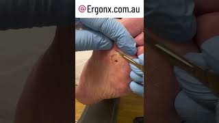 Slomo callus cutting from foot in podiatry clinic full video [upl. by Ezarra]