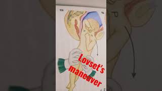 Lovsets Maneuver obstetrician nursing skills procedure nurseslife [upl. by Shipman981]