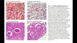 Chronic Interstitial Nephritis amp Papillary Necrosis [upl. by Enaud486]