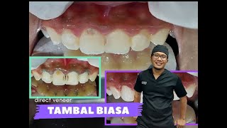 Tambal komposit gigi depan composite direct veneer beserta biaayanya [upl. by Oleg]