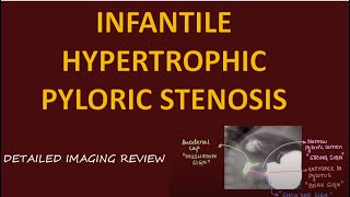 INFANTILE HYPERTROPHIC PYLORIC STENOSIS IHPS Imaging l Multimodality approach and Criterias l [upl. by Saihttam]