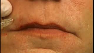 How To Fill Lip Lines Smokers Lines With Dermal Filler [upl. by Aerehs]