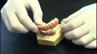 Prothese clipsee sur implant avec barre [upl. by Eikceb]