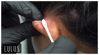 Cartilage Piercing Removal Pus Coming Out [upl. by Angel756]