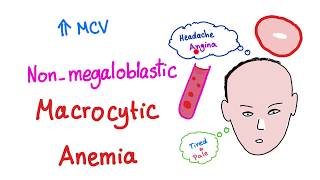 Nonmegaloblastic Macrocytic Anemia [upl. by Franek]