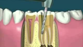 Tratamiento de Endodoncia o Conducto [upl. by Anivahs305]