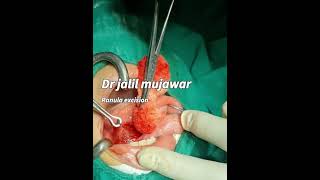 ranula  sublingual mucous cyst excision dr jalil mujawar [upl. by Htbazile]