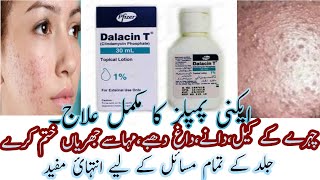 Best Acne Lotion  Dalacin T Lotion  Calindamycin 1 Acne Lotion Review In Urdu Hindi [upl. by Papp768]