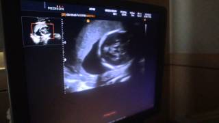 My 5 month uLtrasOund its a BOY Hi Baby [upl. by Mcnalley137]