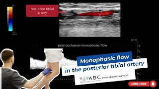 Monophasic flow in the posterior tibial artery  Ultrasound [upl. by Ingvar]