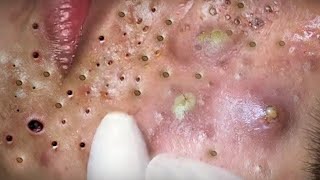 Big Cystic Acne Blackheads Extraction Blackheads amp Milia Whiteheads Removal Pimple Popping 95338 [upl. by Elkcim]