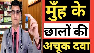 MOUTH ULCERS APHTHAE  मुँह के छालों की अचूक दवा  HOMEOPATHIC TREATMENT [upl. by Tirma]