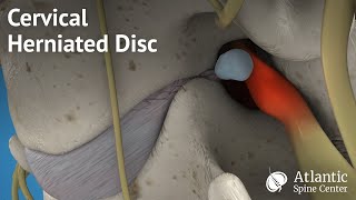 Cervical Herniated Disc [upl. by Ettevets]