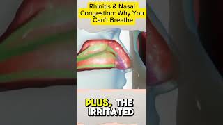 Rhinitis amp Nasal Congestion Why You Cant Breathe rhinitis acnnlifearena shorts [upl. by Adnalue]