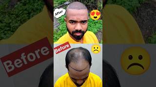 One week journey of Hair Transplant 😍😘❤️ 5M Views 🫶 Thank You Bhai hairtransplant D2LifeVlogging [upl. by Nav167]