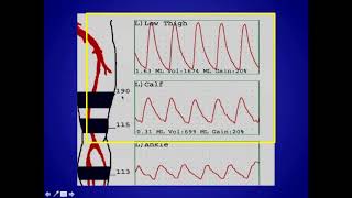 How to Perform and Interpret Peripheral Arterial Doppler Examinations [upl. by Suirtemed]