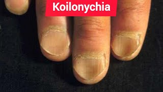 Leukonychia Platynychia and Koilonychia in Chronic iron deficiency anemia [upl. by Modestia]