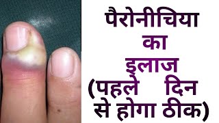 Nail Infection Paronychia  Cause amp Treatment  नाखून संक्रमण का इलाज कैसे करें [upl. by Cnut893]