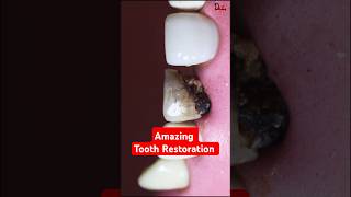 Impossible to save this tooth satisfying asmr missionimpossible [upl. by Eeral574]