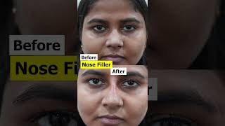 Nose Filler  Nose Filler cost shortvideo shorts [upl. by Ahseek]