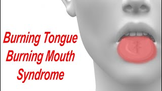 Burning Tongue and Burning Mouth Syndrome Causes and Treatment [upl. by Chance457]