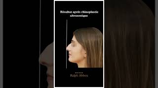 Résultat 1 semaine après rhinoplastie ultrasonique par Dr Abbou [upl. by Lachman]