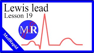 Lewis lead in EKG [upl. by Marih]