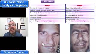 39 Facial Nerve Paralysis Diagnosis [upl. by Ennaeerb942]