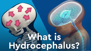 What is Hydrocephalus and Why Does Fluid Build Up in the Brain [upl. by Vere464]